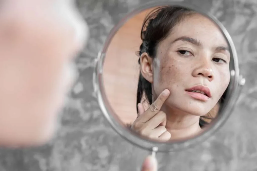 cara menghilangkan flek hitam di hidung
