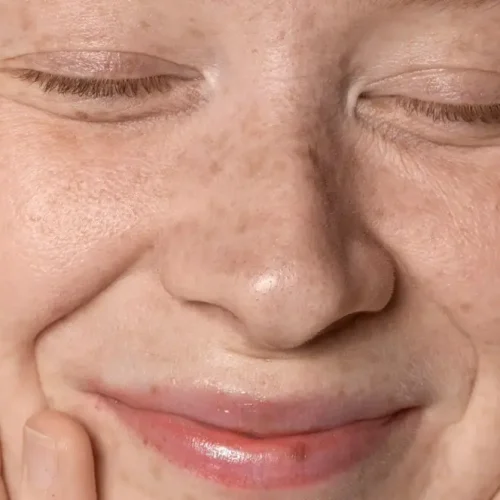 cara menghilangkan smile line