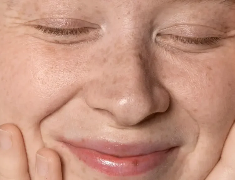 cara menghilangkan smile line