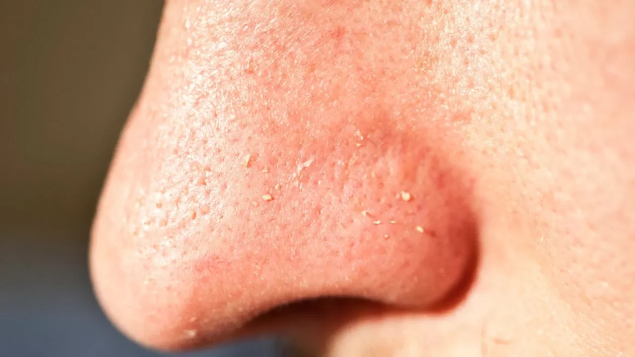 Kok Bisa Pori-Pori Tersumbat? Yuk Cari Tahu Penyebab Clogged Pores yang Bikin Kulitmu Kusam!