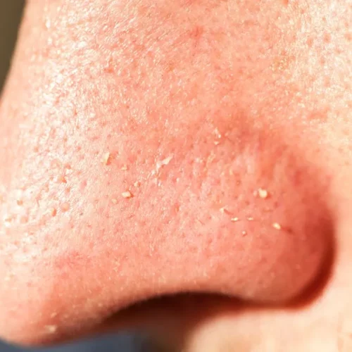 clogged pores