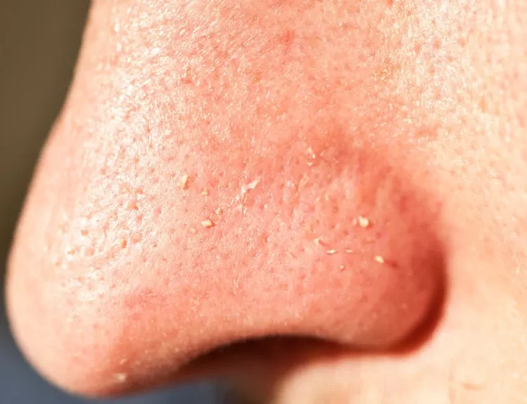 clogged pores