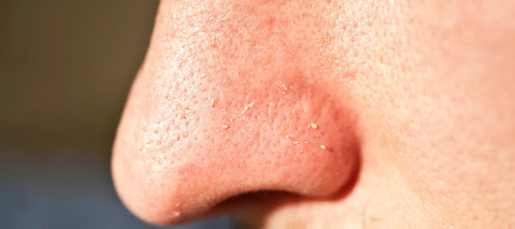 clogged pores