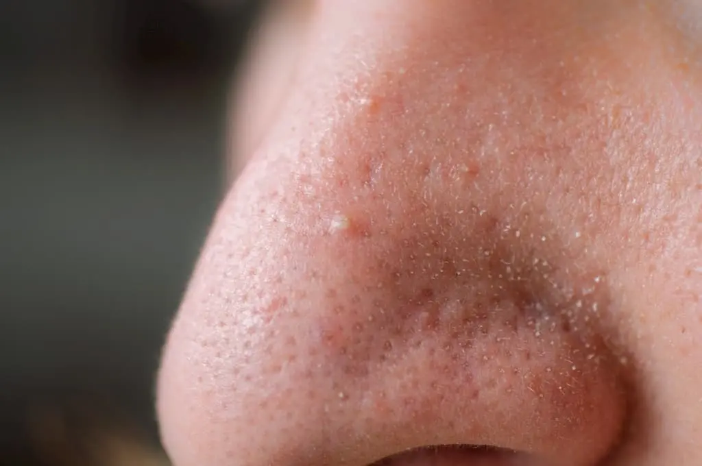 clogged pores