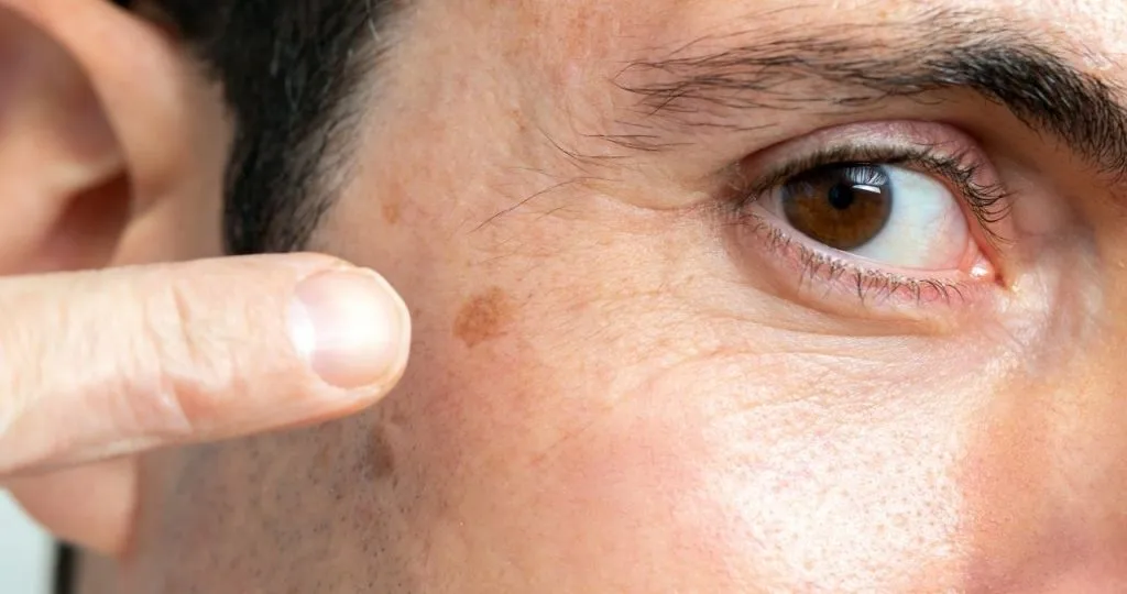 dark spot