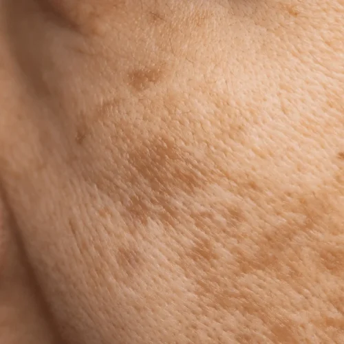 dark spot