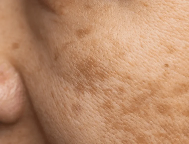 dark spot