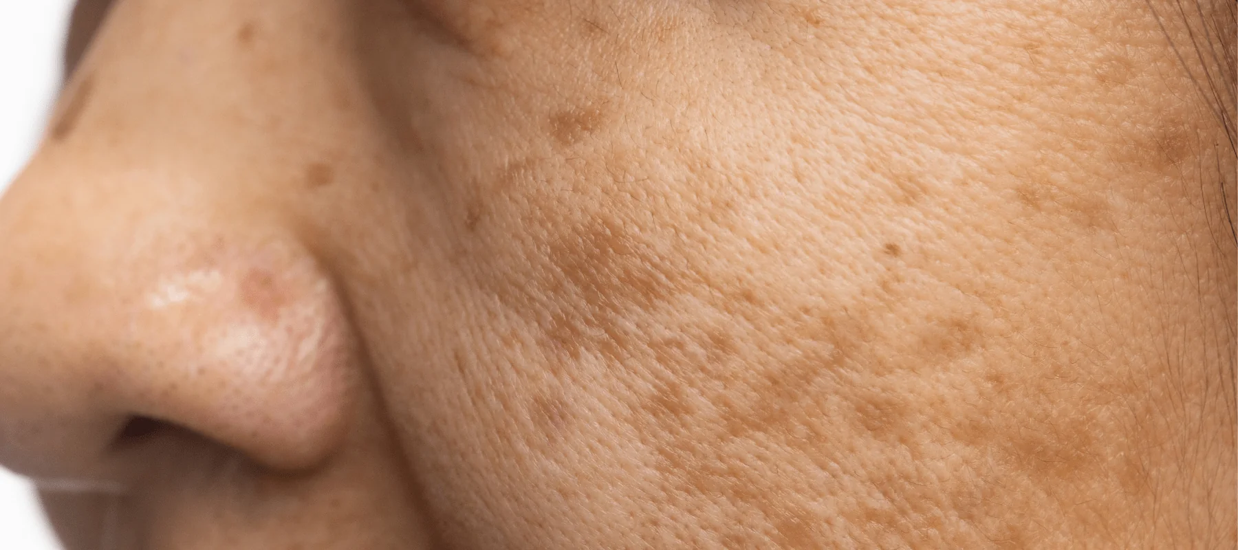 dark spot