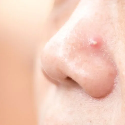 cara mengecilkan hidung