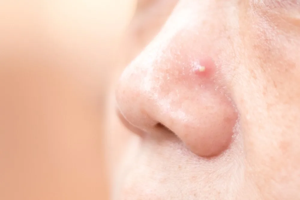 jerawat batu di hidung