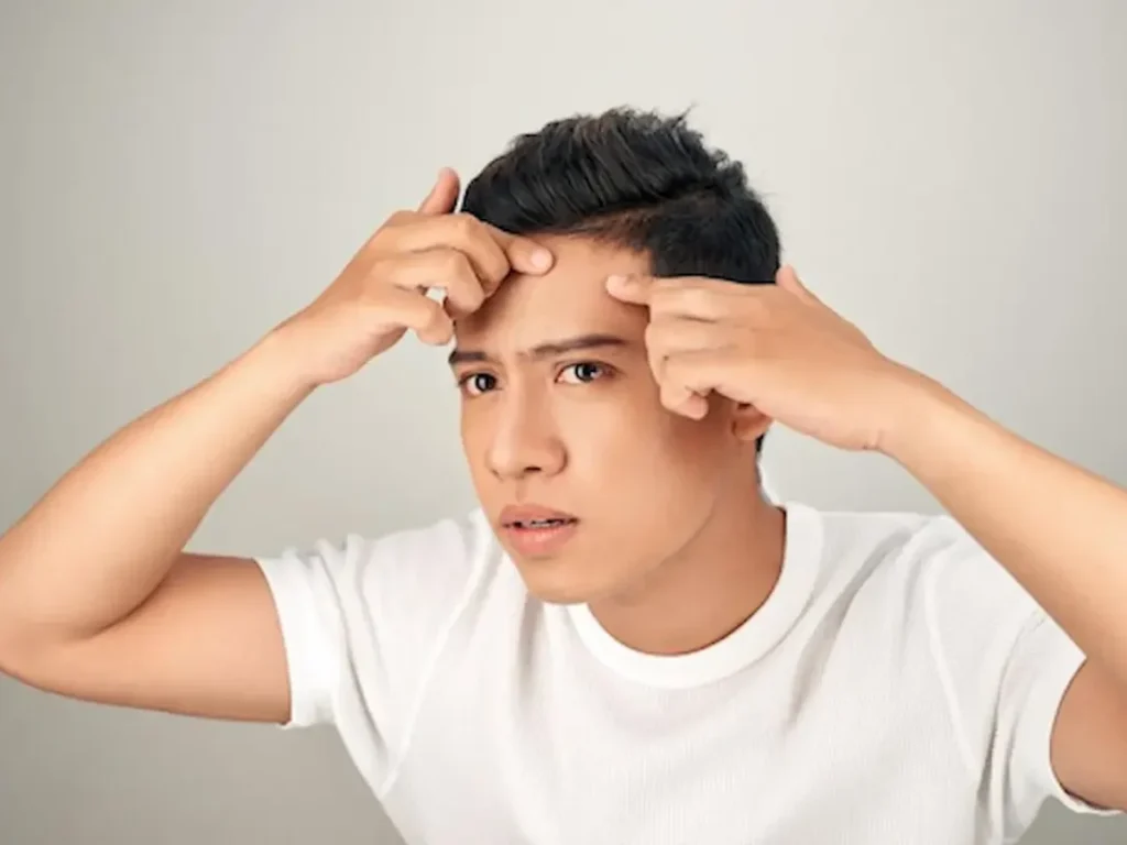 jerawat di jidat