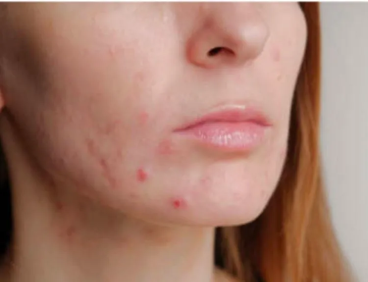 blemish adalah