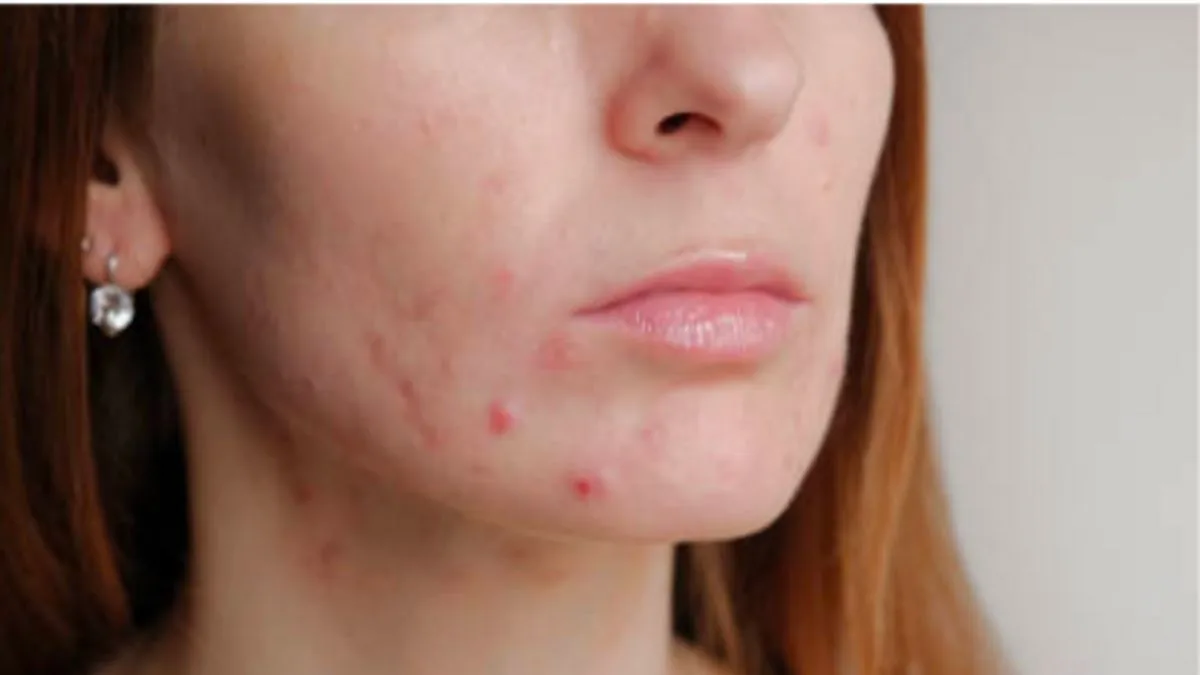 blemish adalah