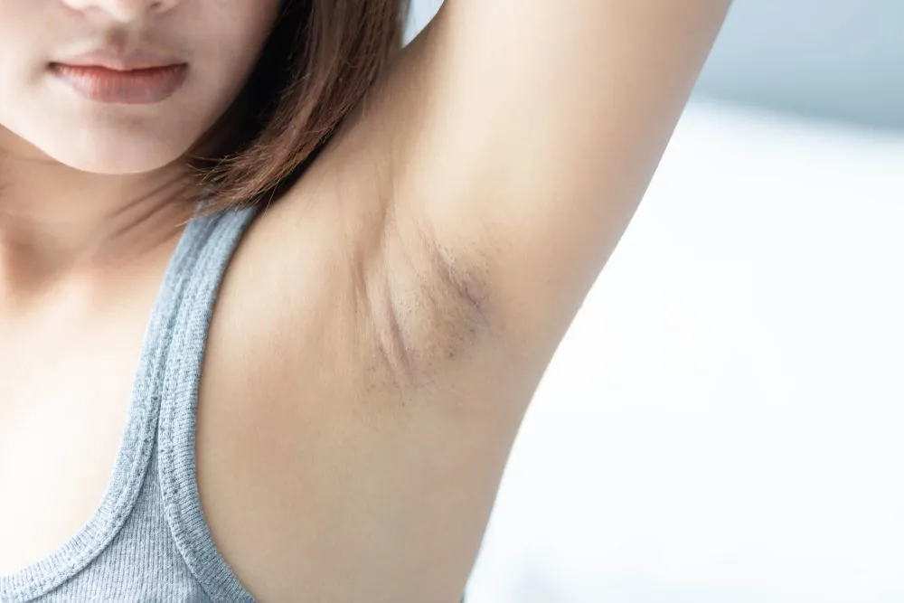 manfaat bio oil untuk ketiak hitam