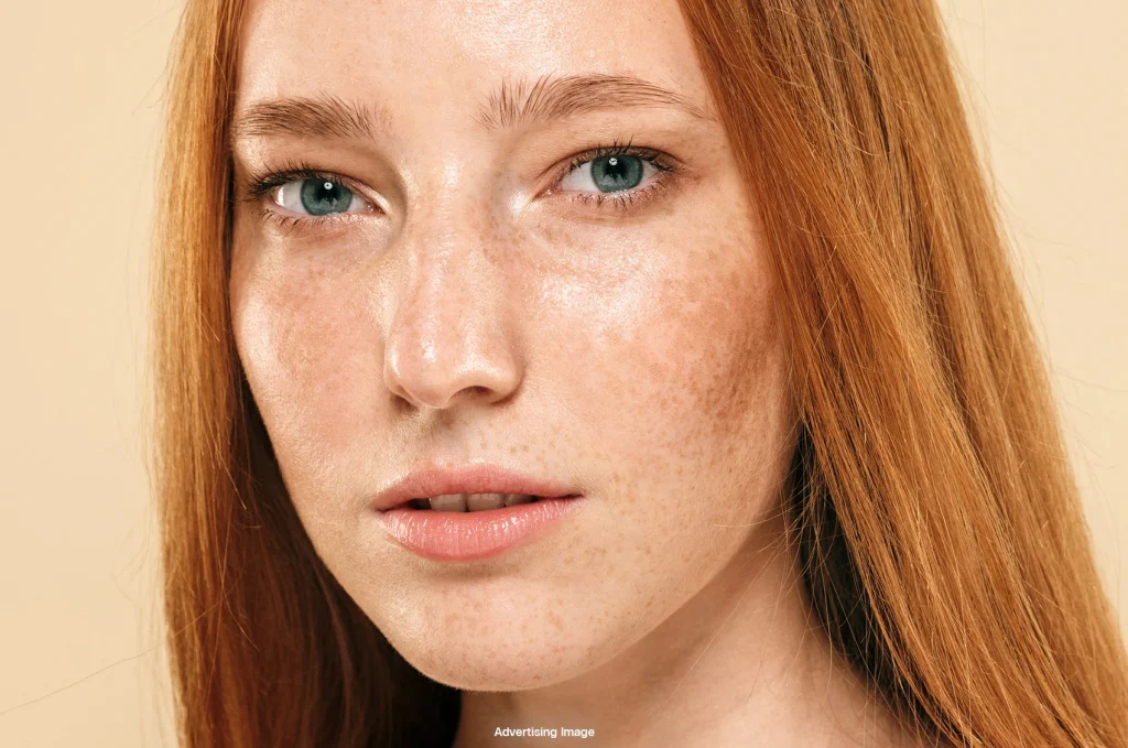 melasma