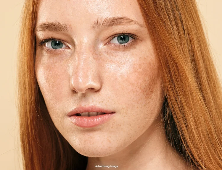 perbedaan melasma dan flek hitam