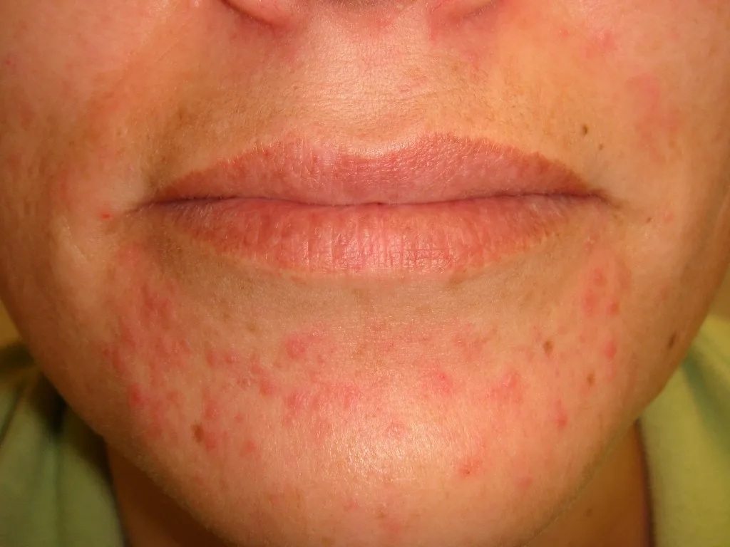 pelembab untuk dermatitis perioral