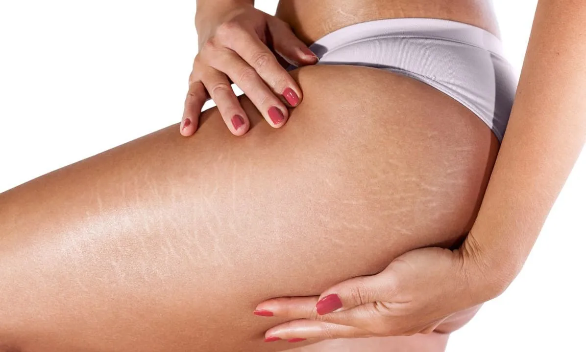 Kenapa Stretch Mark di Paha Tiba-Tiba Muncul dan Bikin Kamu Penasaran?