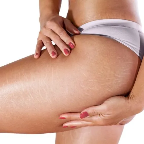 penyebab stretch mark