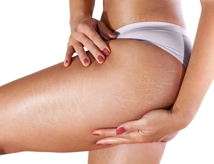 penyebab stretch mark