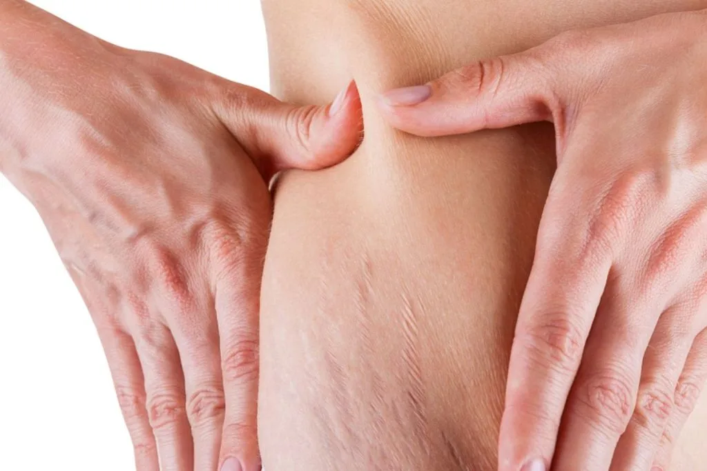 penyebab stretch mark