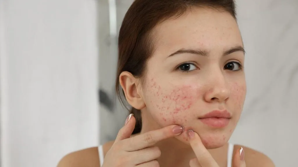 wajah purging dan breakout