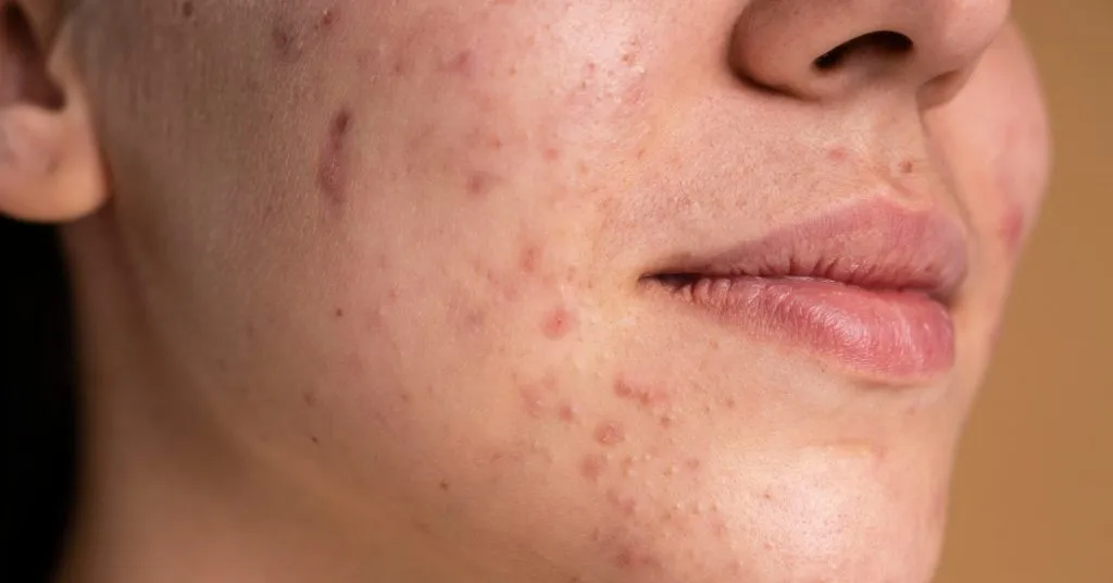 acne scar
