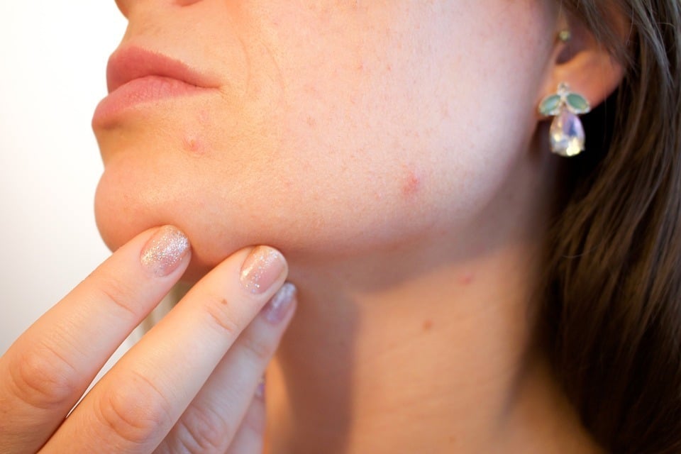 acne scar