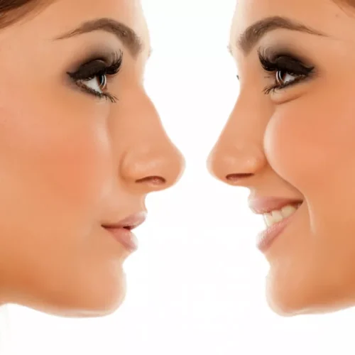 cara memancungkan hidung secara alami