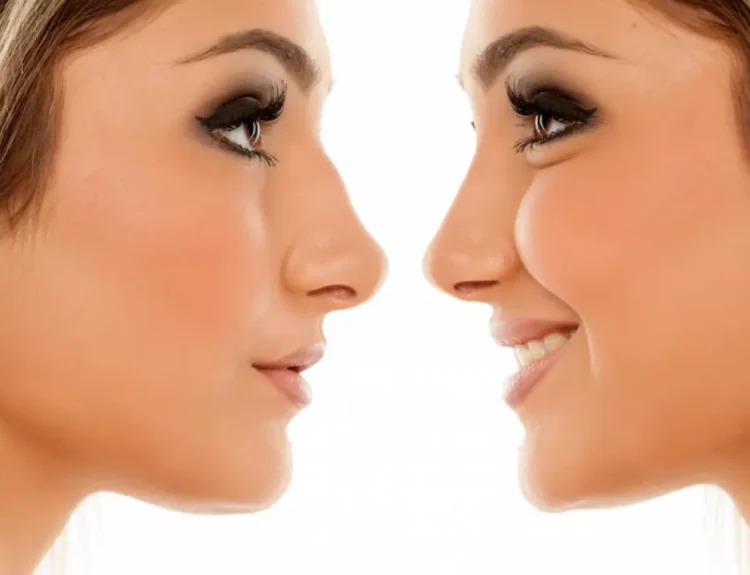 cara memancungkan hidung secara alami