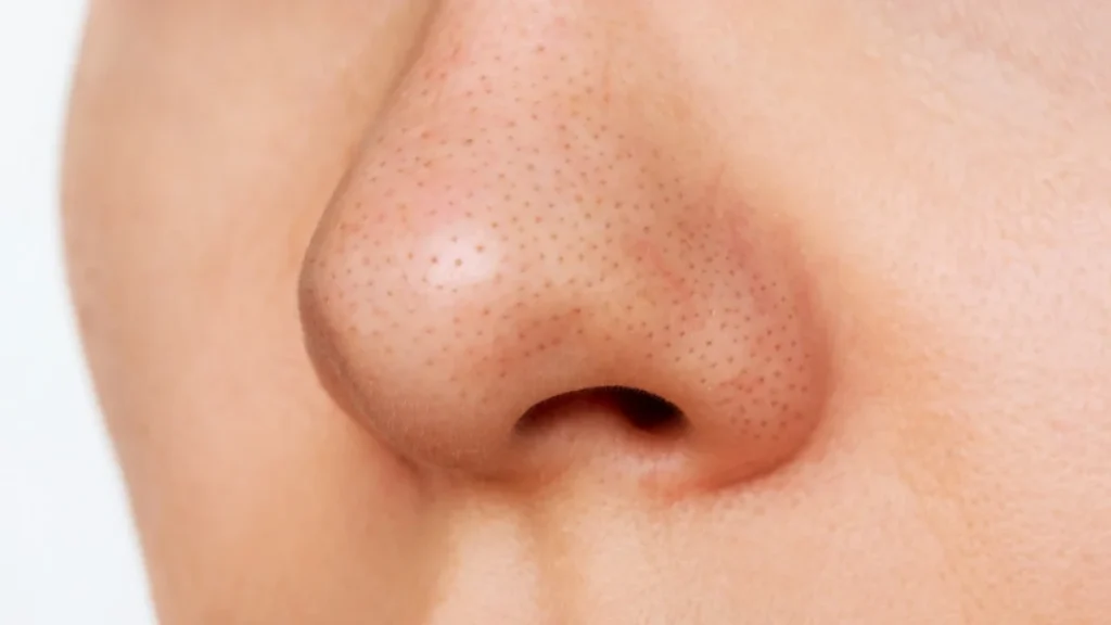 cara menghilangkan komedo hitam di hidung