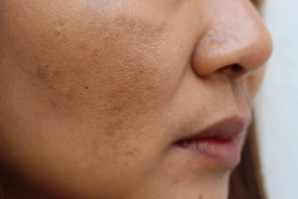 dull skin adalah