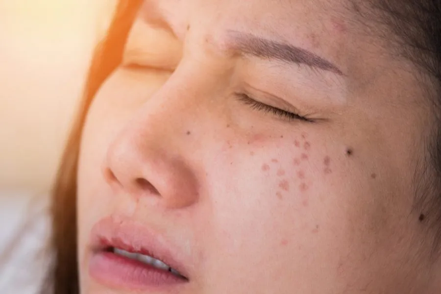 melanin adalah