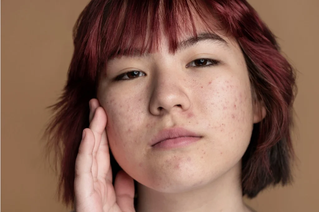 perbedaan melasma dan flek hitam